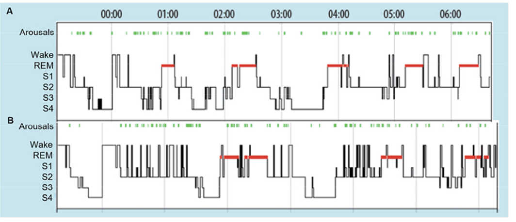 <ul><li><p>increased <span><span>sleep disruption, mainly sleep awakenings</span></span></p></li><li><p><span><span>menopause is fluctuations and eventual decline in oestrogens</span></span></p></li><li><p><span><span>Lampio et al 2017 - the only longitudinal study of sleep and menopause at baseline and 6 years later with 60 women participants (47-52years of age)</span></span></p></li><li><p><span><span>(pre-menopause at the top of graph)</span></span></p></li></ul><p></p>