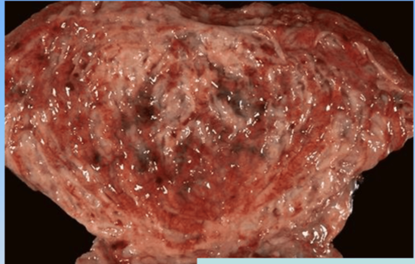 <p>inflammation of the bladder</p>