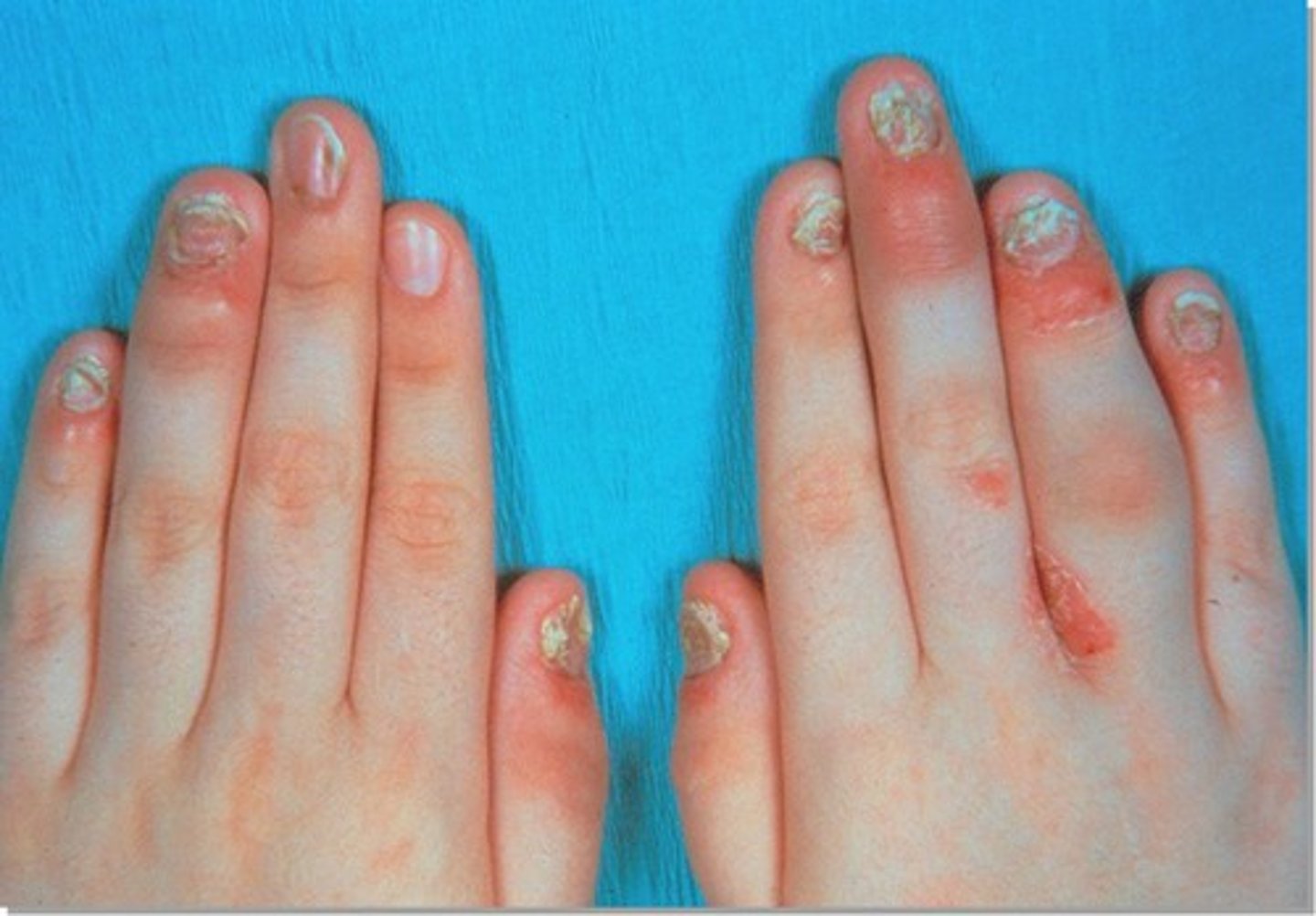 <p>Any form of inflammatory arthritis associated with/ psoriasis that is RF-</p><p>Arthritis: DIP, sausage digits, sacroiliitis</p><p>Nails: pitting, transverse depression and onycholysis</p><p>Eyes: conjunctivitis. anterior uveitis</p>