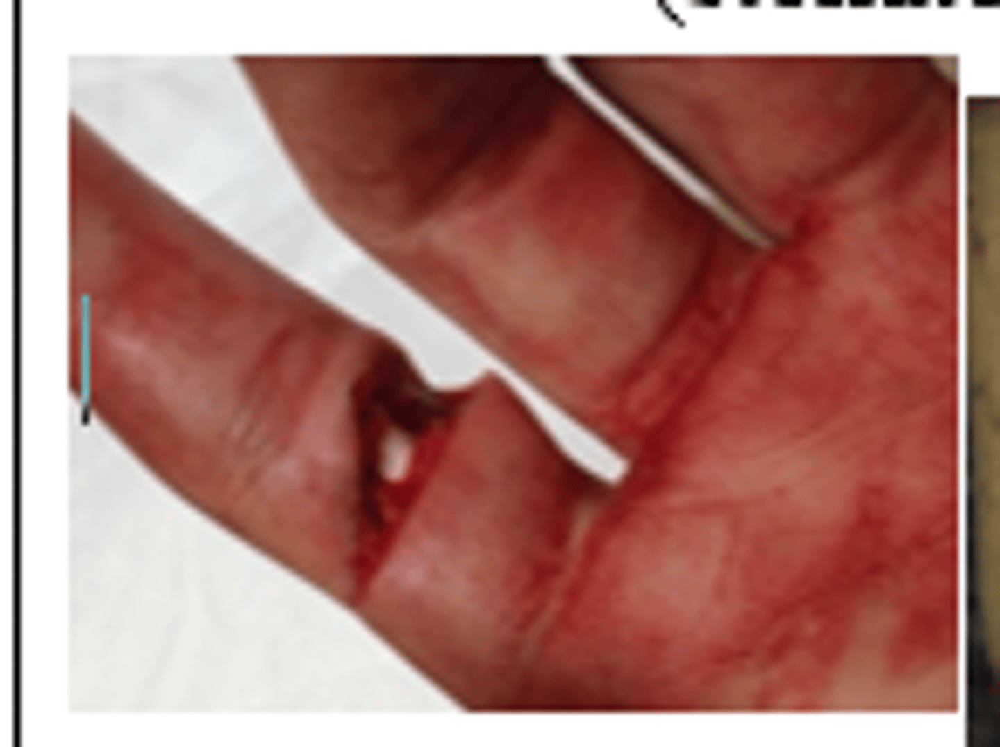 <p>Shearing (simple cut caused by knife or glass dividing of tissue)</p>