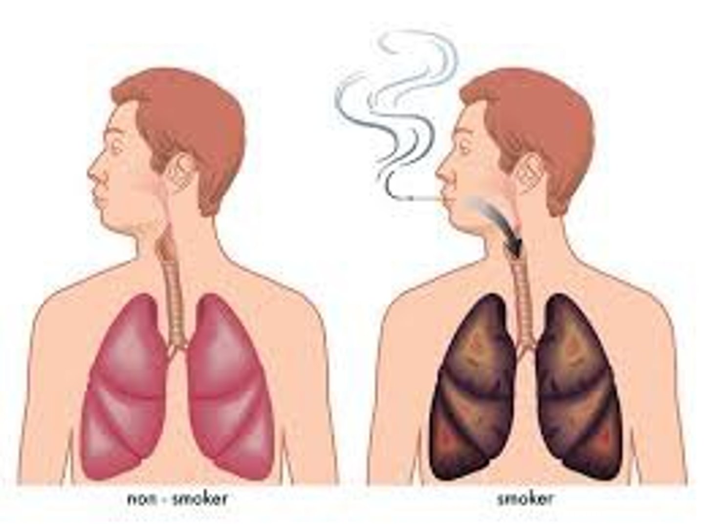 <p>a. Smoking and environmental tobacco smoke (ETS) health effects:</p><p>i. Adults: lung cancer</p><p>ii. Fetus/infants: prenatal complications, low birth weight, infant mortality</p><p>1. Pneumonia and hospitalization in year 1 is 38% higher</p><p>2. Infant mortality is 80% higher</p><p>3. 5 times higher risk of sudden infant death syndrome (SIDS)</p><p>4. 20% of all infant deaths could be avoided if all pregnant smokers stopped by the 16th week of gestation.</p><p>iii. Children whose mothers smoke: 70% more respiratory problems</p><p>b. Vaping</p><p>i. Contain: nicotine, VOC, PM, diacetyl (linked to cancer), cancer-causing chemicals</p><p>ii. Lung cancer</p>