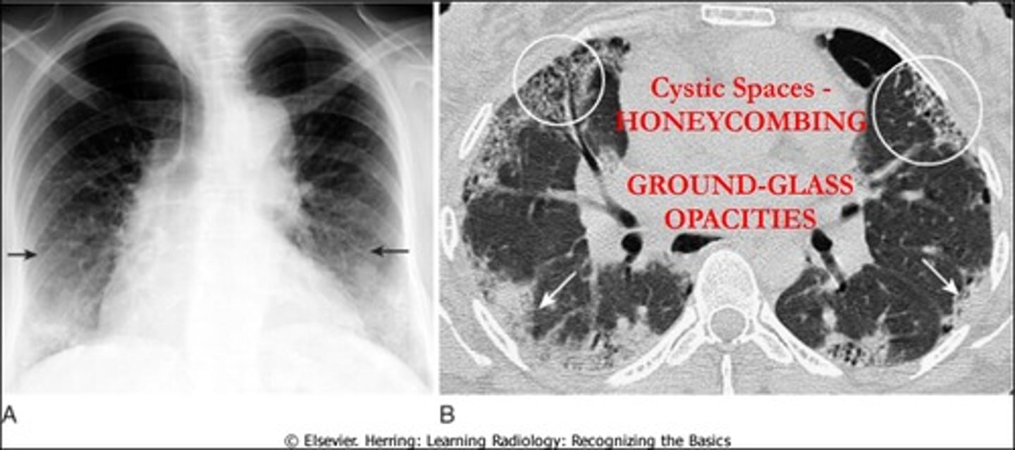 <p>- Diffuse patchy fibrosis: bases</p><p>- Reticular honeycombing</p><p>- Focal ground glass opacification</p><p>- Traction bronchiectasis</p>