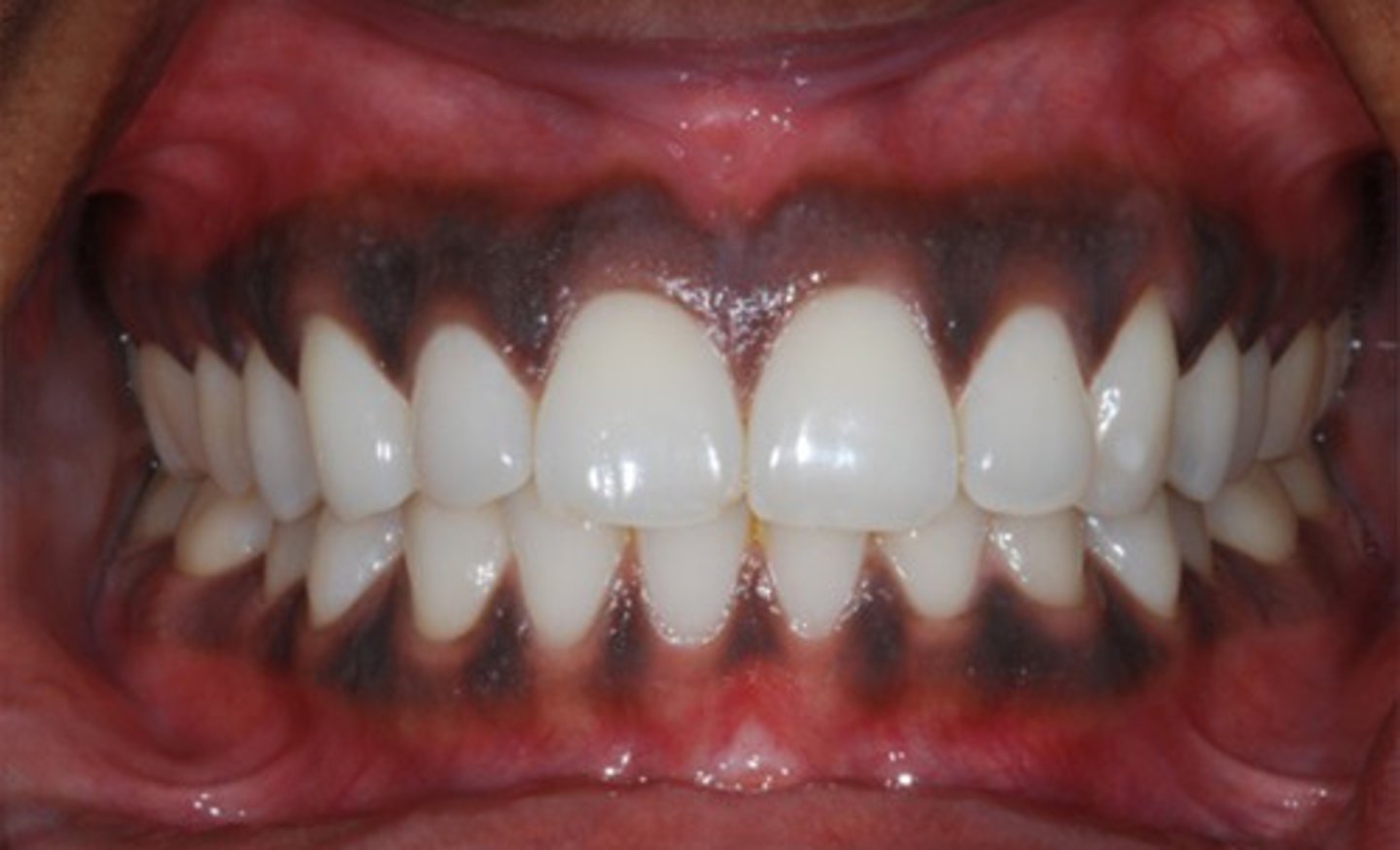 <p>diffuse or localized brown pigmentation of the mucosa</p>