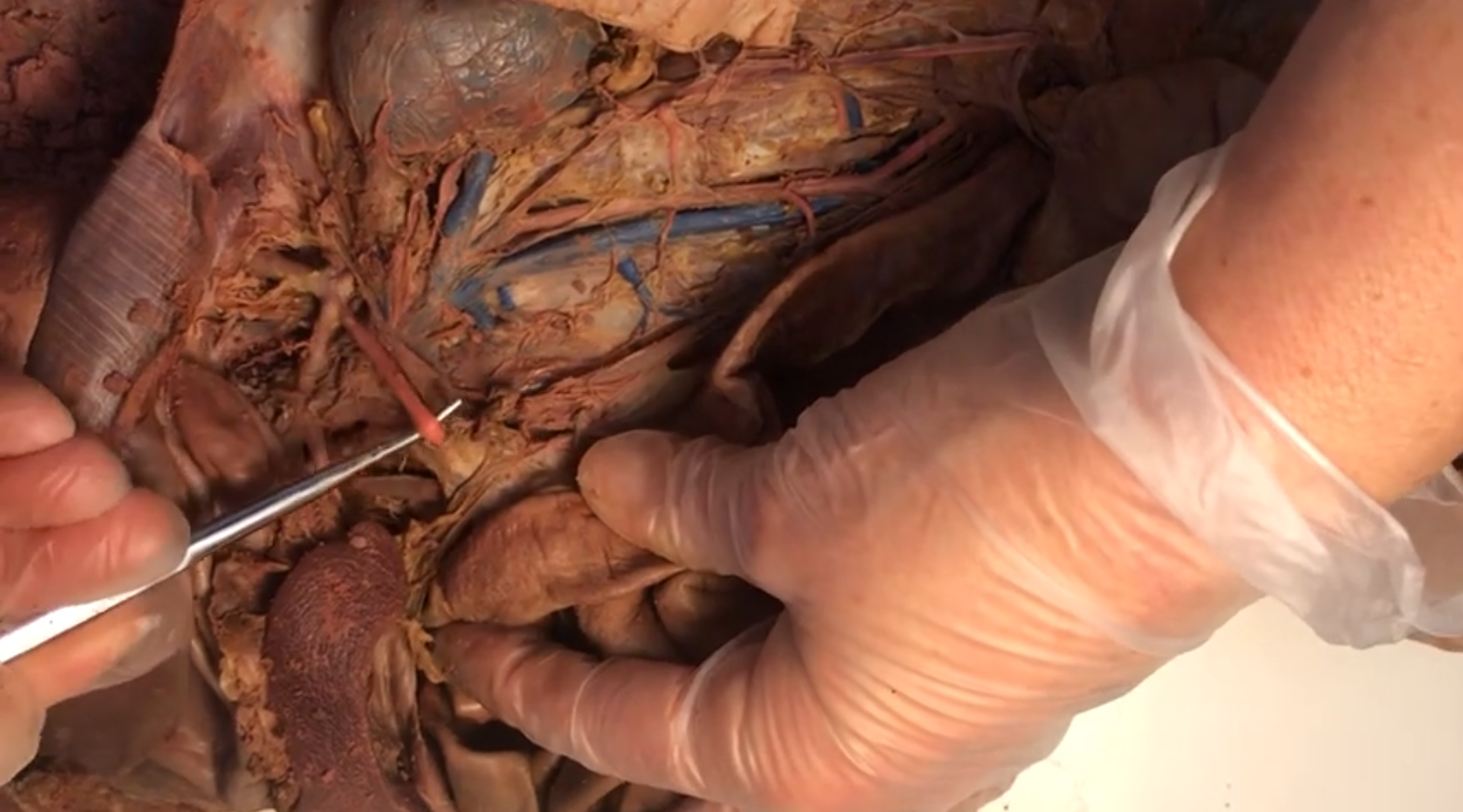 <p>What artery is this</p>