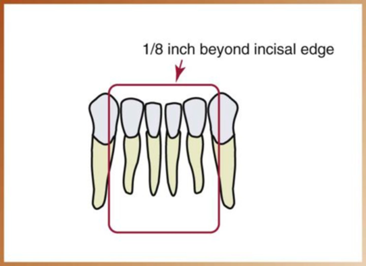 <p>1. receptor placement</p><p>2. receptor position</p><p>3. vertical angulation</p><p>4. horizontal angulation</p><p>5. receptor exposure</p>