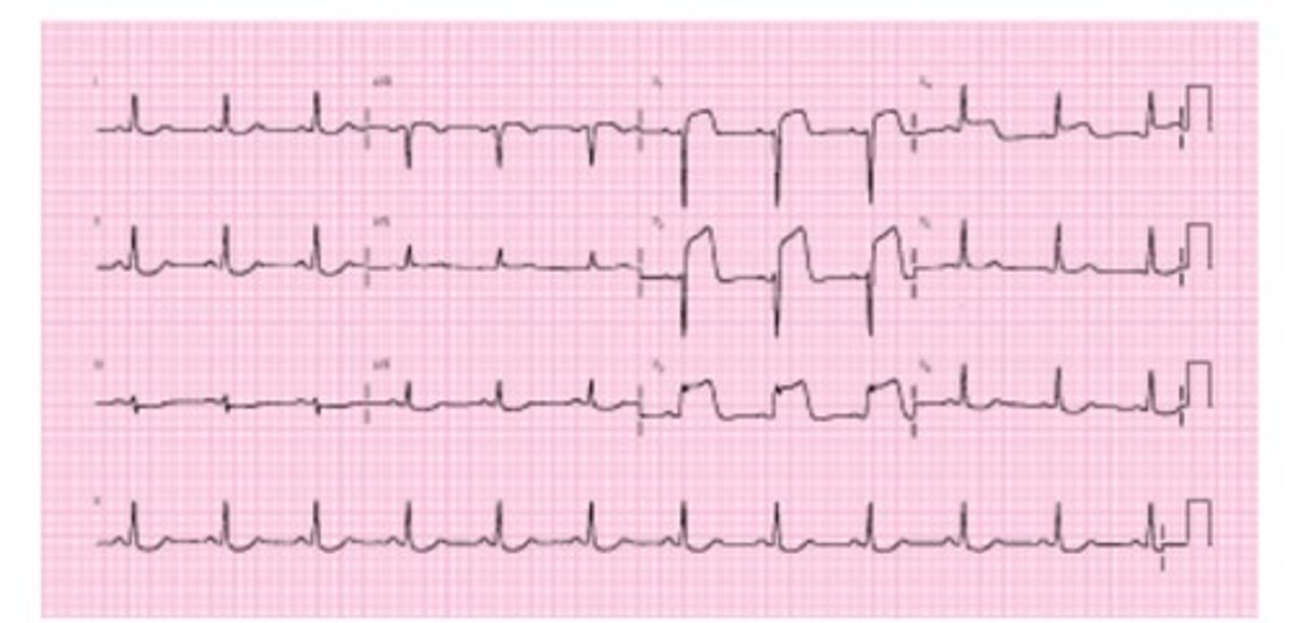 <p>D) anterior wall</p>