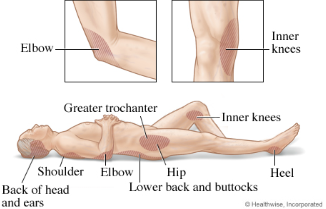 <ul><li><p>lower back *</p></li><li><p>hip *</p></li><li><p>greater trochanter *</p></li><li><p>inner knee *</p></li><li><p>heel *</p></li><li><p>elbows</p></li><li><p>calves</p></li></ul><p></p>