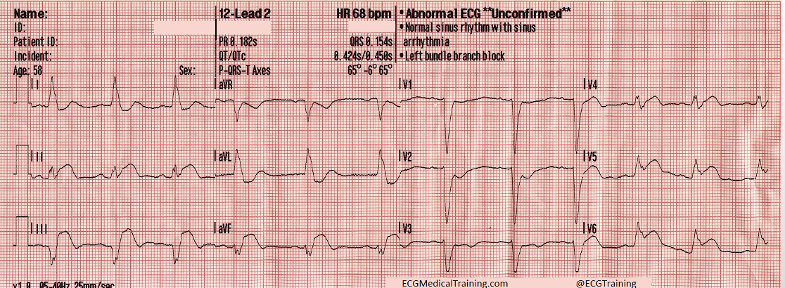 <p>concordant ST elevation of 1+ mm in any lead w/ a + QRS complex</p><p>concordant ST depression of 1+mm in V1-V3</p><p>discordant ST elevation of 5+ mm in any lead w/ - QRS complex</p>