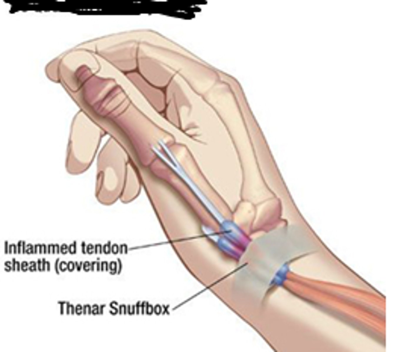 <p>Inflammation of the tendon sheath where muscle connects to bone.</p>