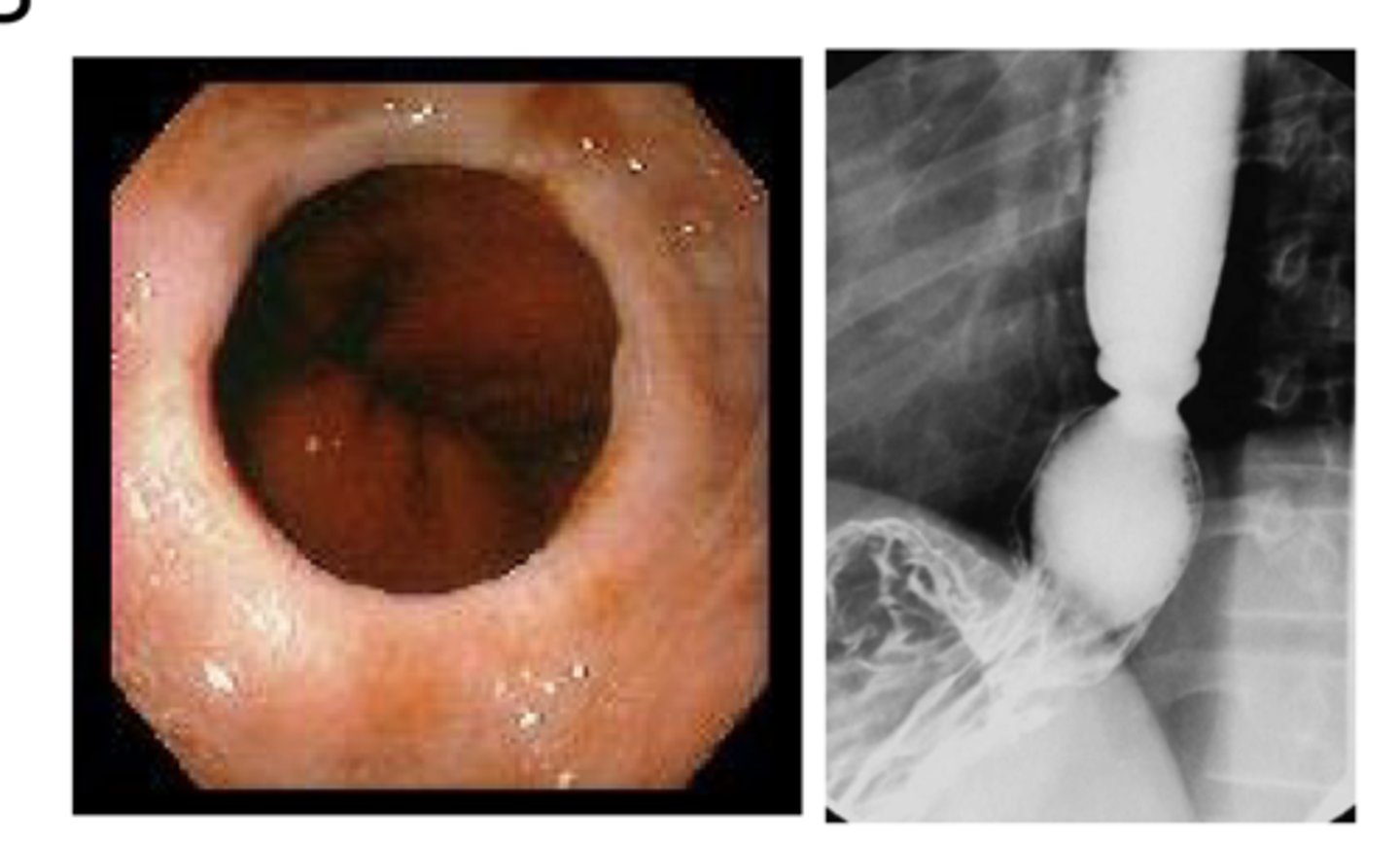 <p>dysphagia to large solids</p>