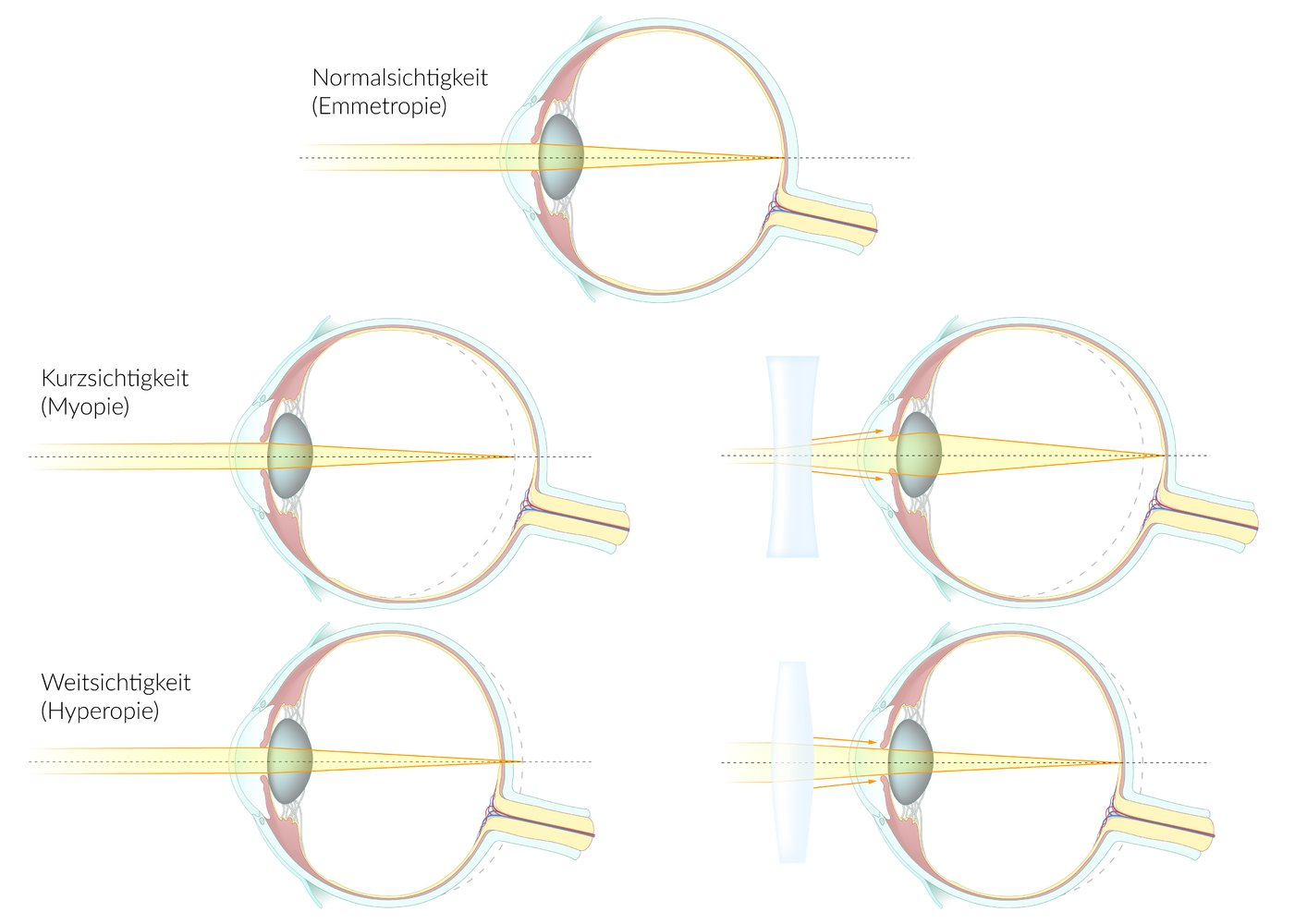 <ul><li><p>Bulbus zu kurz (bei Weitsichtigkeit = Hyperopie) / Strahl trifft zu weit hinten→ Sammellinse</p></li><li><p>Bulbus zu lang (bei Kurzsichtigkeit = Myopie) / Strahl zu kurz→ Streulinse</p></li></ul><p></p>