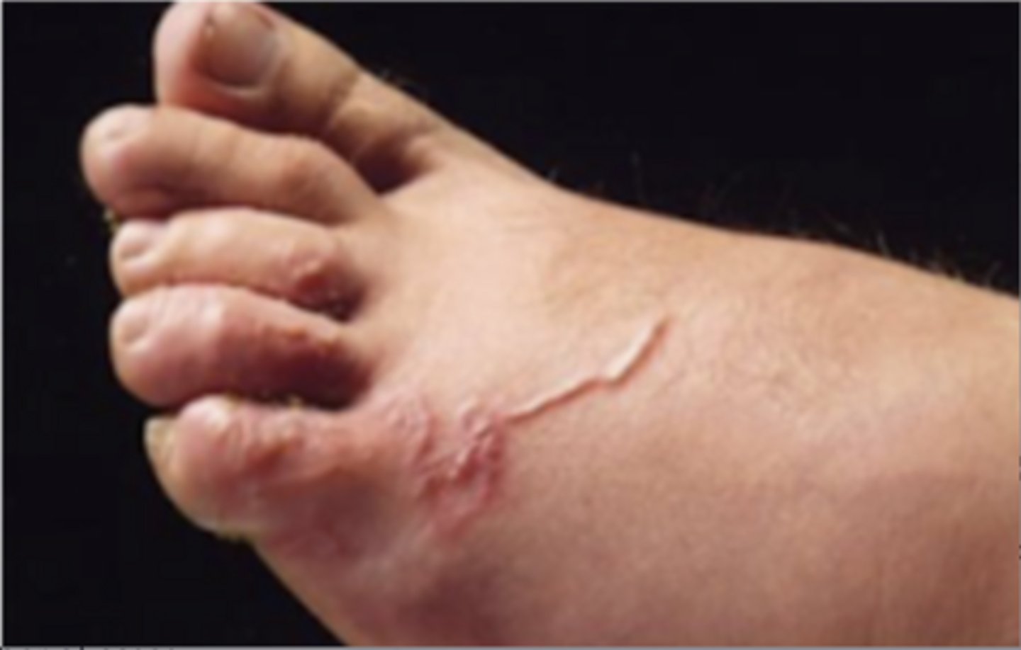 <p>What disease is depicted in this picture?</p>