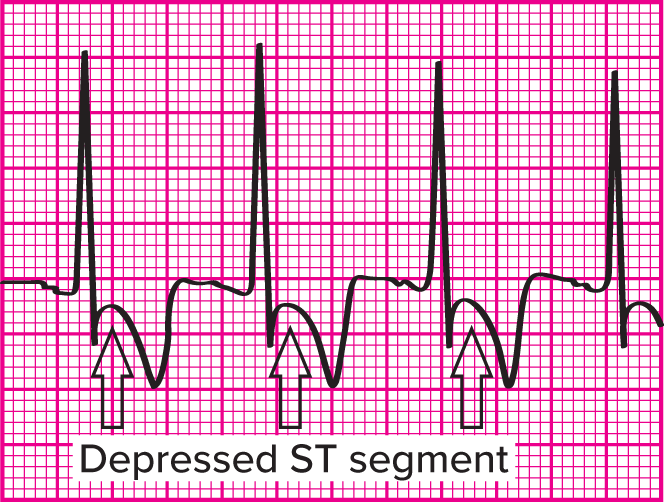 <p>An abnormally low ST segment below the normal baseline of the ECG. It may indicate myocardial ischemia, which can occur during exercise electrocardiography.&nbsp;</p>
