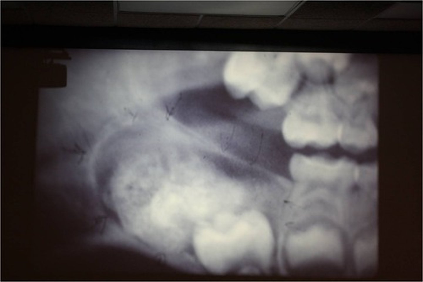 <p>posterior mandible</p>