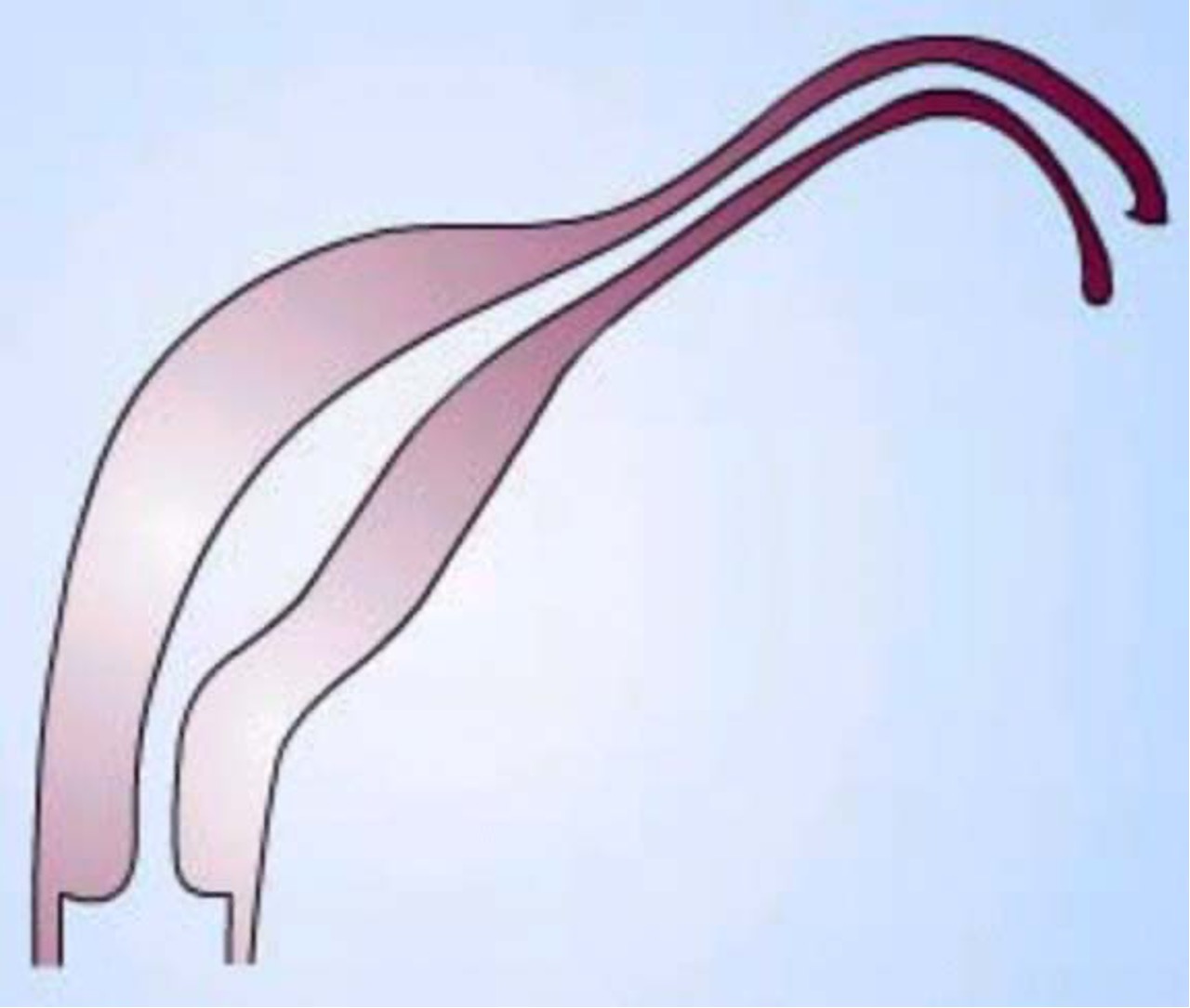 <p>What class mullerian defect is this?</p><ul><li><p><strong>unicornuate uterus</strong> → result of complete/almost complete arrest of development of 1 Müllerian duct</p><ul><li><p>incomplete arrest (MC) → rudimentary horn w/ or w/o functioning endometrium</p></li><li><p>if horn obstructed, may need surgery, enlarging pelvic mass</p></li></ul></li><li><p>if contralateral healthy horn is almost fully developed, a full term pregnancy is believed to be possible</p></li></ul><p></p>