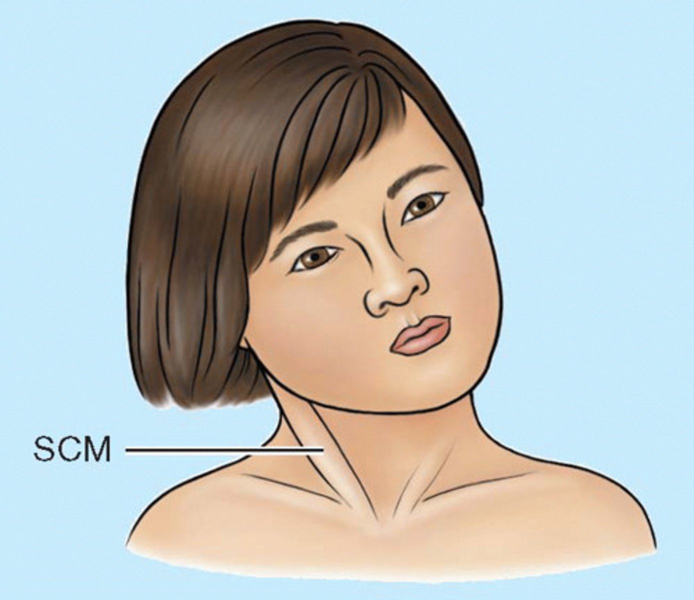 <p>spasmodic torticollis or wryneck - an acquired issue in adults</p>