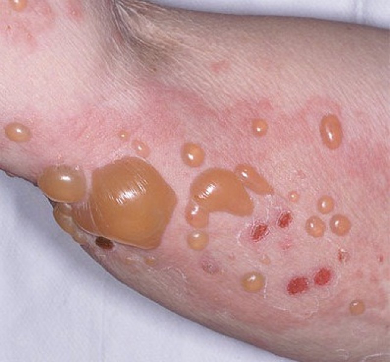 <p>small clear fluid-filled elevation</p>