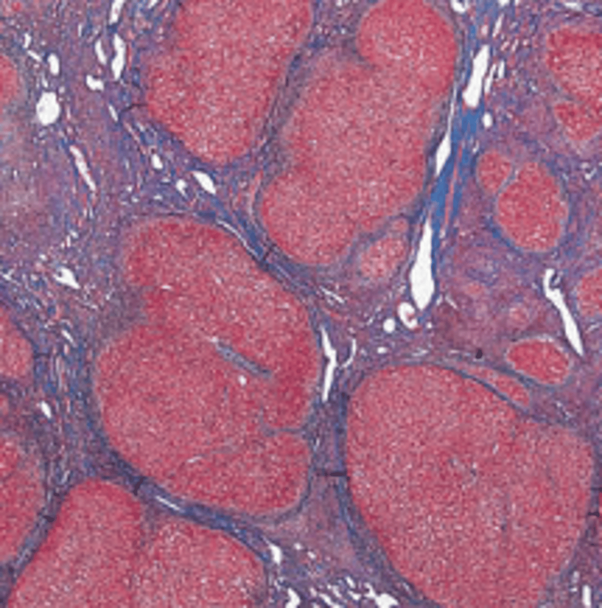 <p>A 60-year-old man is found in a state of disorientation and is brought to the emergency room in a comatose state. He lived alone, ate poorly, and drank large amounts of hard liquor. Physical examination reveals an emaciated man with a distended abdomen, jaundice, ascites, and a slightly enlarged liver and spleen. A liver biopsy is shown in the image. What blood test would conﬁrm a diagnosis of hepatic coma?</p><p>(A) Alanine aminotransferase</p><p>(B) Alkaline phosphatase</p><p>(C) Ammonia</p><p>(D) Bilirubin</p><p>(E) Urea nitrogen</p>