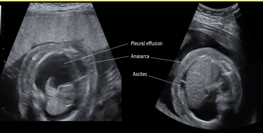 <p>what is <strong>anasarca</strong> commonly seen with</p><p>a) achondrogenesis</p><p>b) IUGR</p><p>c) fetal hydrops </p><p>d) thanatophoric dwarfism </p>