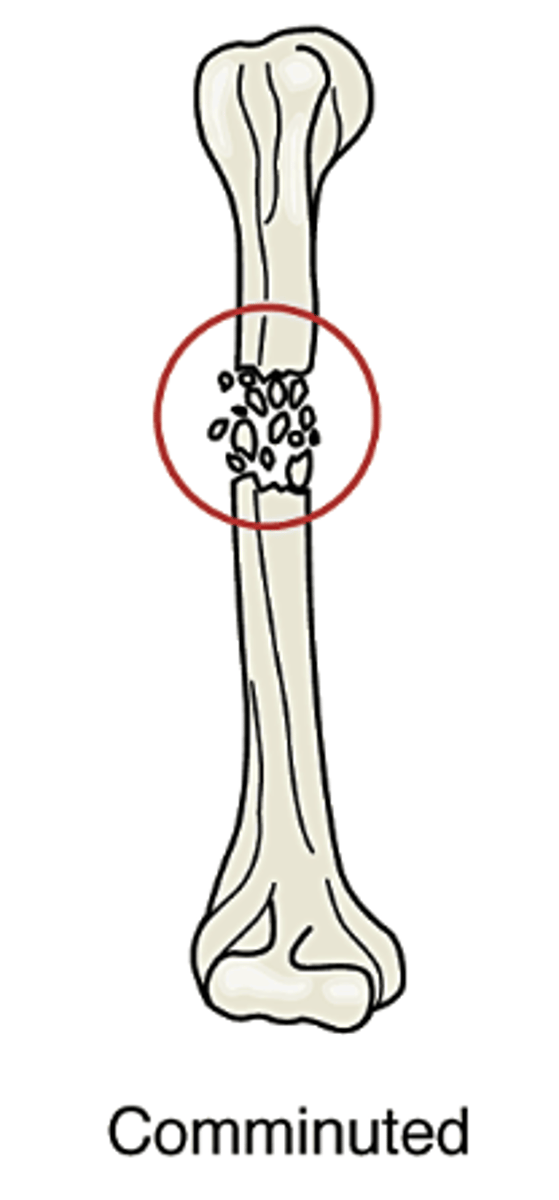 <p>Bone is splintered or shattered into numerous fragments. often occurs in crushing injuries.</p>