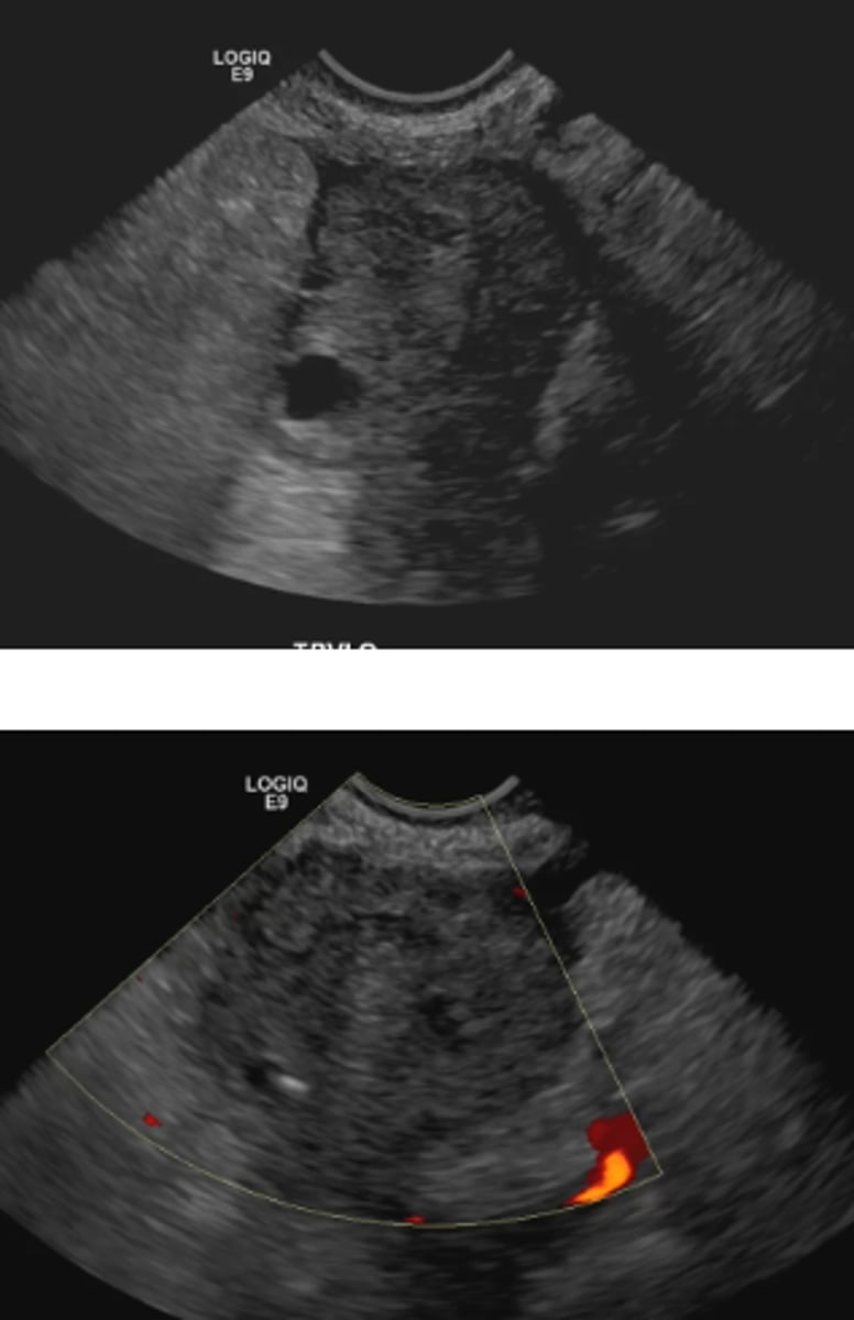 <p>Ovarian torsion</p><p>-The images show an enlarged ovary with a heterogeneous texture and absent internal vascularity=torsion</p>