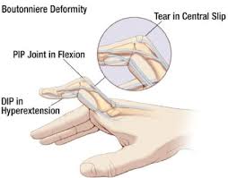 <ul><li><p><span>Rupture of extensor tendon dorsal to the middle phalanx-bone passes through central slip</span></p></li><li><p><span>Forces DIP joint into extensions and PIP Joint into flexion</span></p></li></ul><p></p>