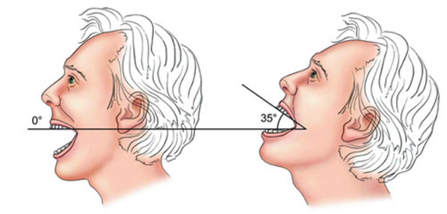 <p>Upper-lower dental angle</p>
