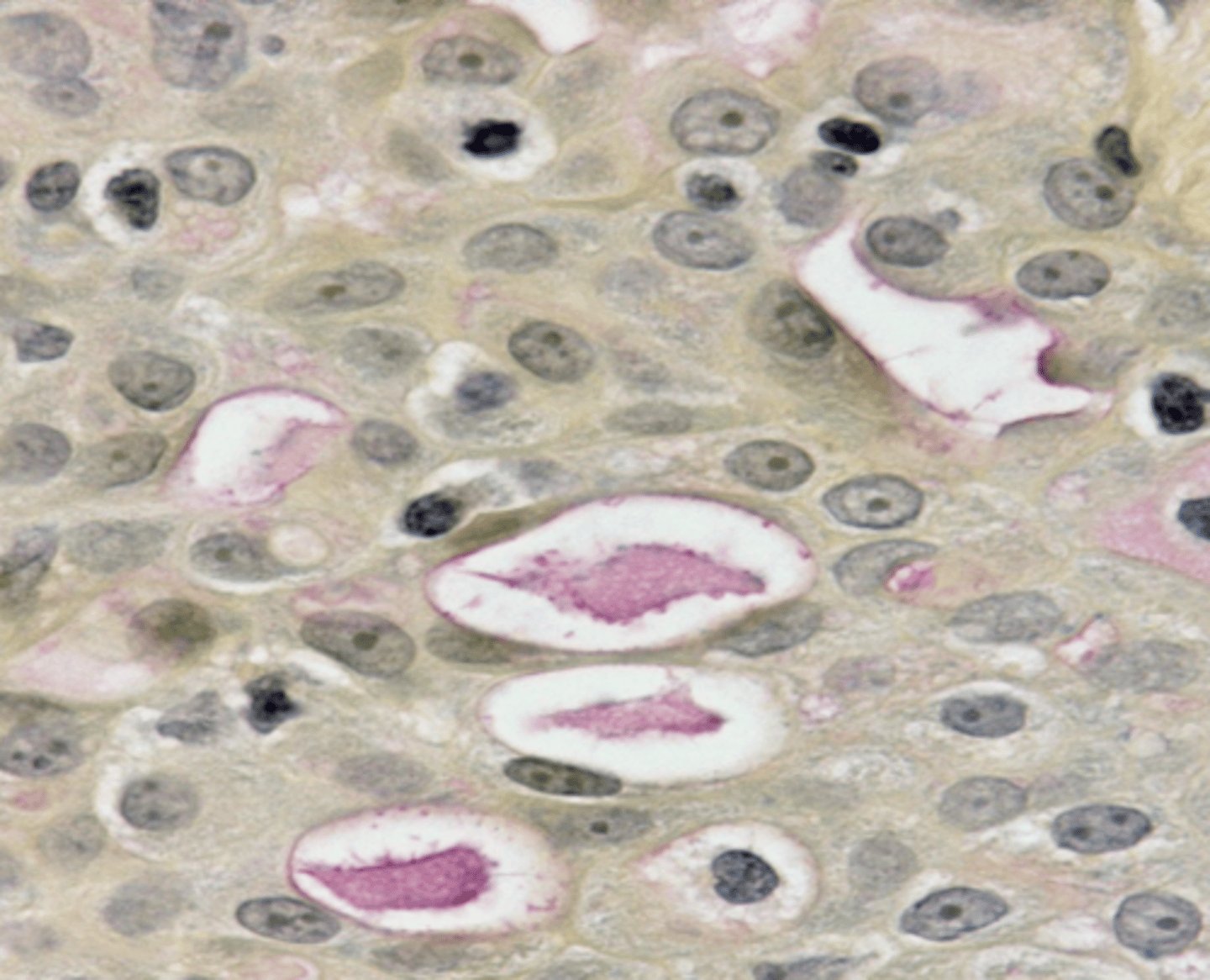<p>Mucicarmine stain</p>
