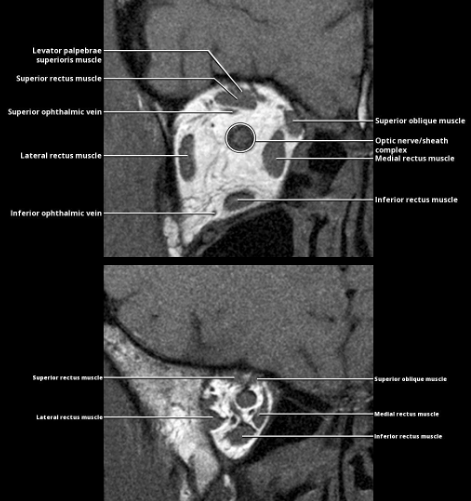 <p>levator palpebrae superioris muscle</p>