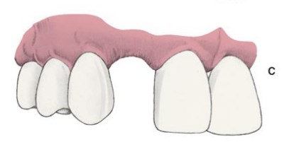 <p>loss of ridge height (vertical loss) w normal ridge width </p>