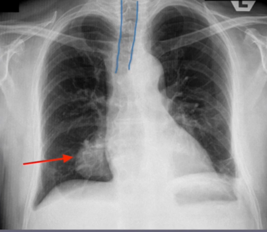 <p>What is the diagnosis based off of this chest x-ray?</p>