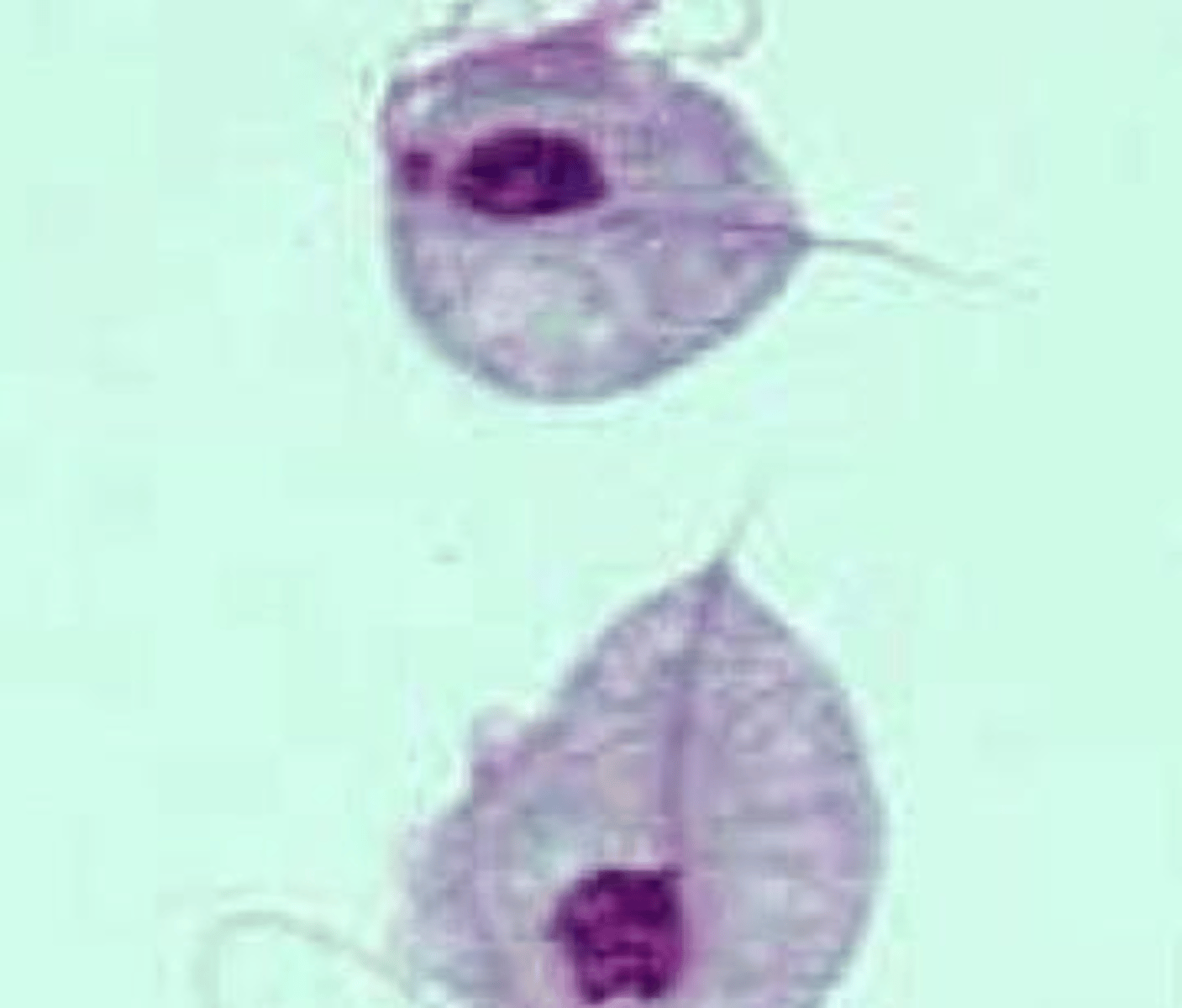 <p>A 'strawberry cervix' (petechial hemorrhages on the vaginal mucosa or cervix) and frothy, yellowish-green malodorous discharge.</p>