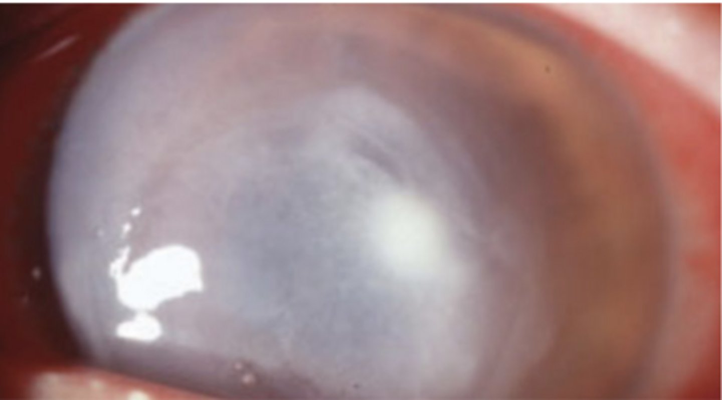 <p>What is the classic presentation of pseudomonas?</p>