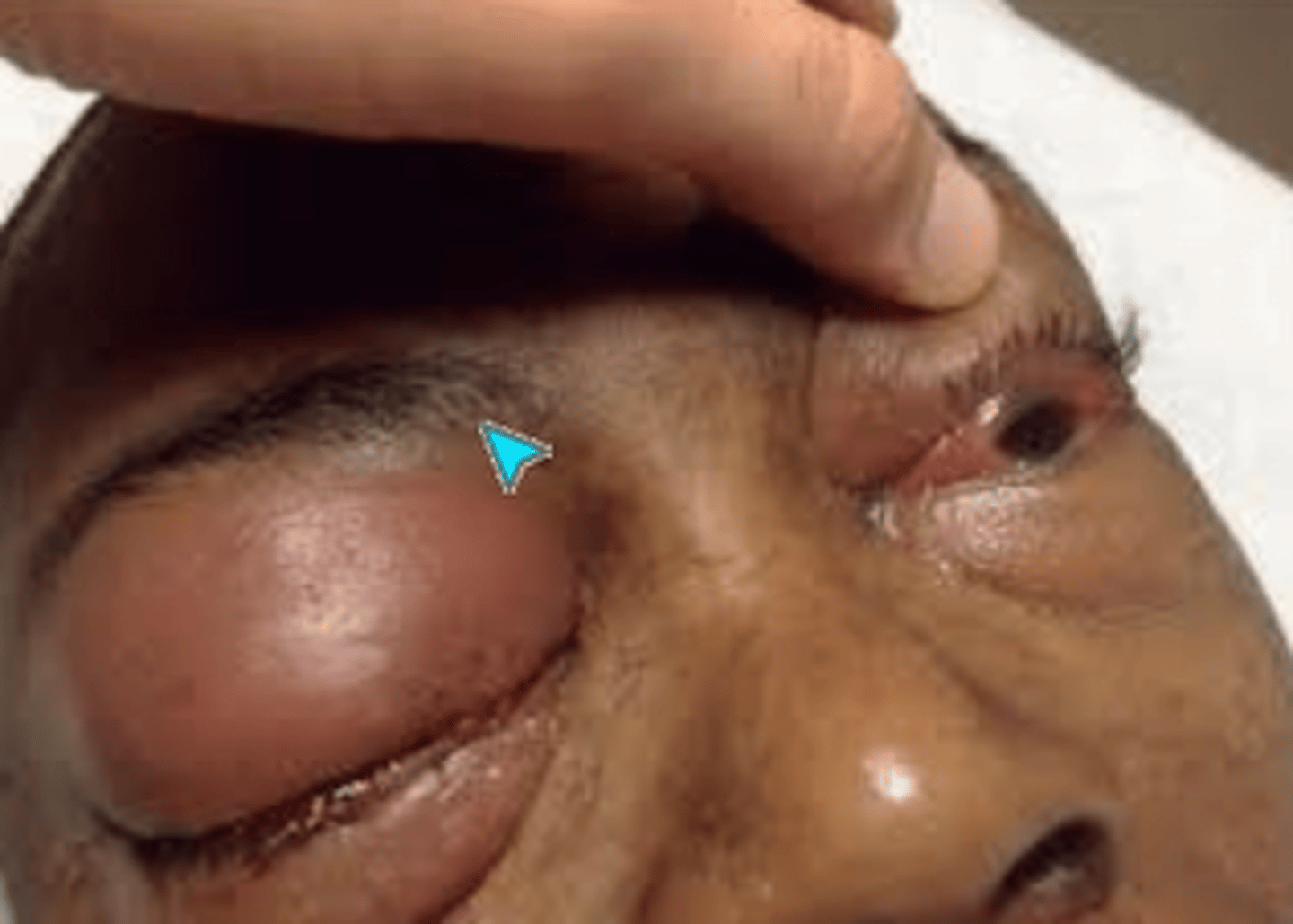 <p>- Proptosis</p><p>- Fever</p><p>- Altered state of consciousness</p><p>- Orbital cellulitis</p>