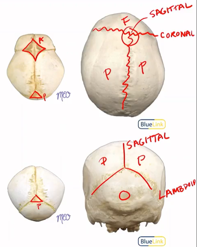 <p>Sagittal and Lambdoid</p>