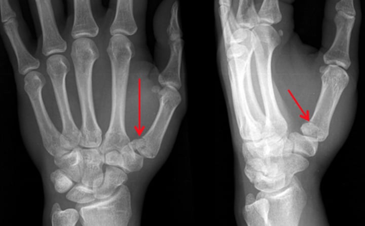 <p>Fx at base of 1st metacarpal</p>