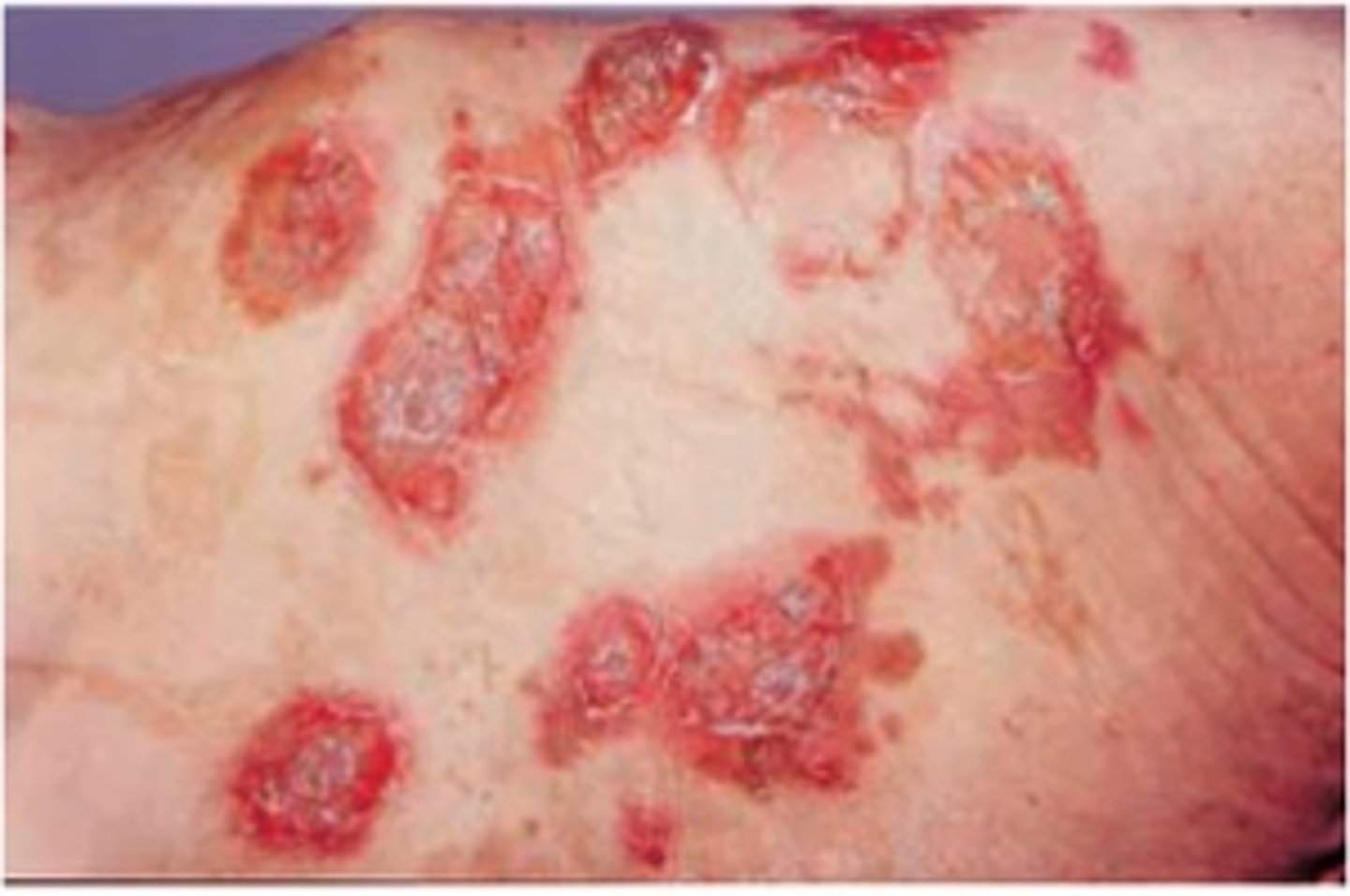 <p>Define Condition:</p><p>Type of Islet Cell Tumor/PanNET</p><p>-Hx:</p><p>&gt; Usually in ADULTS</p><p>-Path: Tumor of pancreatic alpha cells --&gt; Overproduce glucagon</p><p>&gt; Functional Tumor</p><p>&gt; May be part of MEN1 Syndrome</p><p>-Sx/PE: (6 Ds)</p><p>&gt; Dermatitis (Necrolytic migratory erythema = red, blistering, itchy, painful rash; fluctuates in severity; usually seen in genitals, buttocks, groin, and extremities)</p><p>&gt; Diabetes</p><p>&gt; DVT</p><p>&gt; Declining wt</p><p>&gt; Depression</p><p>&gt; Diarrhea</p>