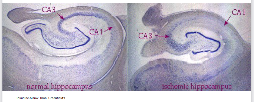 <ul><li><p>ziekte van Alzheimer</p></li><li><p>zeer gevoelig voor ischemie &amp; epilepsie</p></li></ul><p></p>