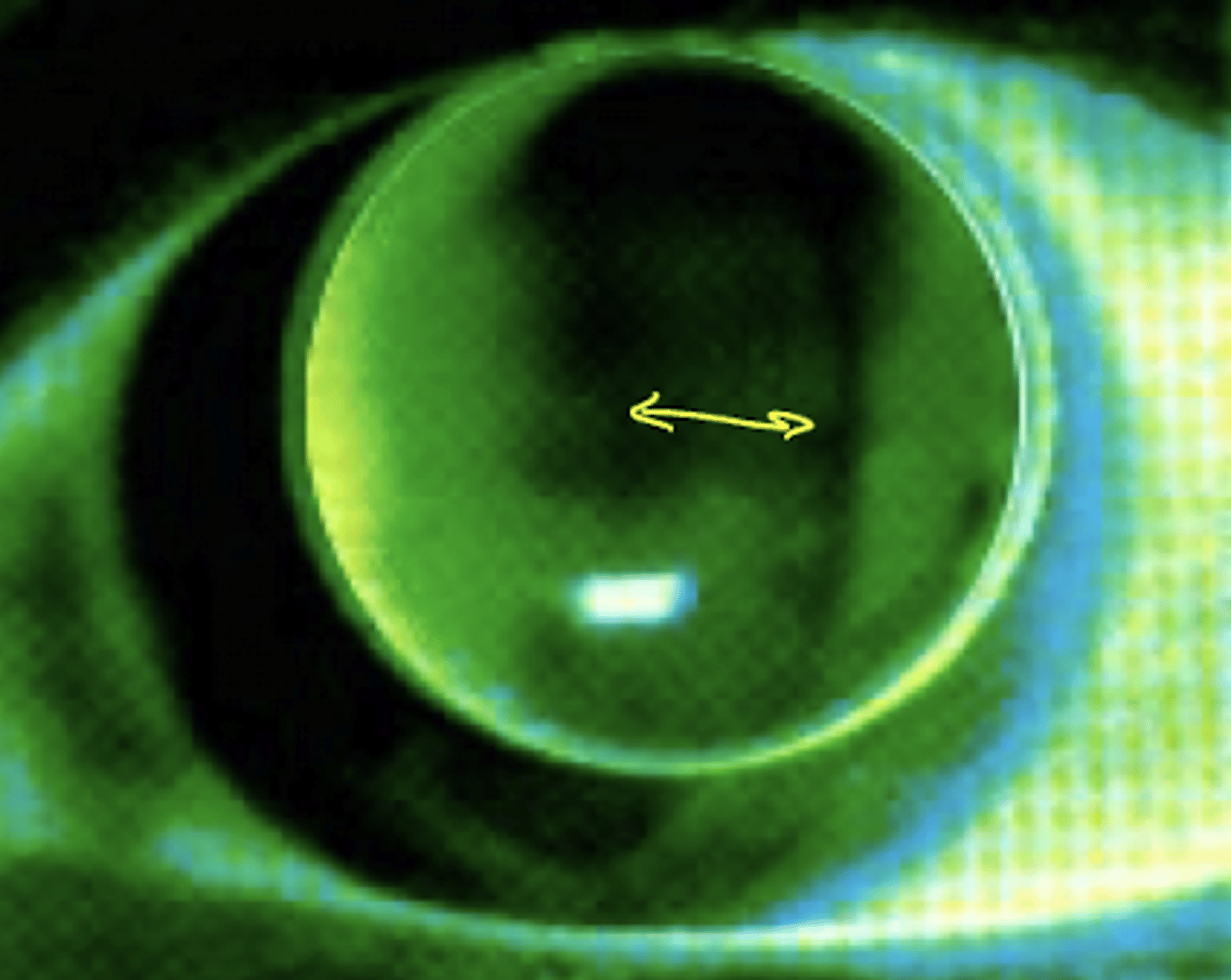 <p>what astigmatism fluorescein pattern</p>