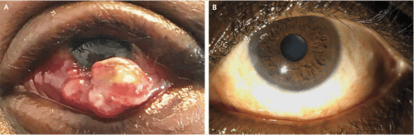 <p>- kaposi sarcoma (most common in AIDs)</p><p>- HIV retinopathy, uveitis, dry eye</p>