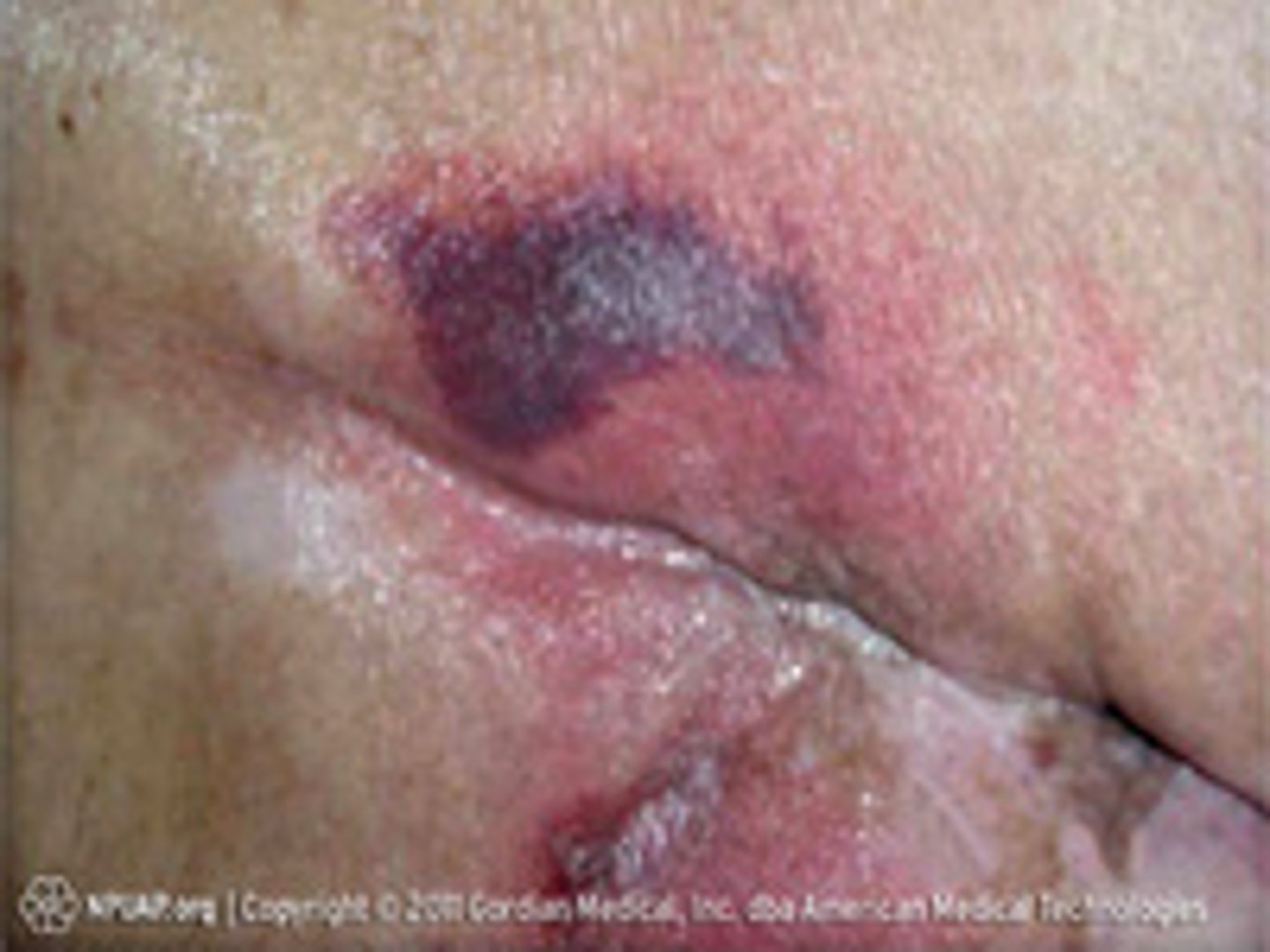 <p>Purple or maroon localized area of discolored intact skin or blood-filled blister</p>