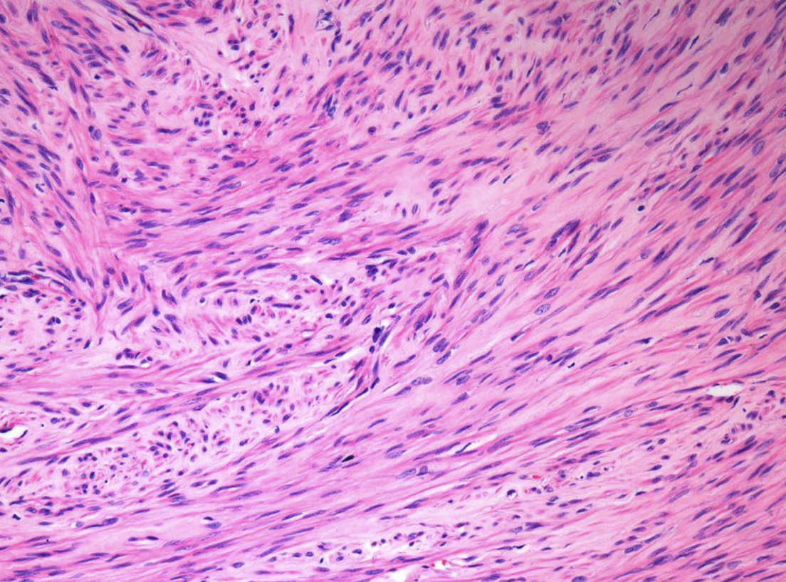 <p><span><span>Describe the gross appearance.</span></span></p><p style="text-align: left;"><span><span>What is the cell of origin?</span></span></p><p style="text-align: left;"><span><span>What is the diagnosis?</span></span></p><p style="text-align: left;"><span><span>What is the malignant counterpart called?</span></span></p>