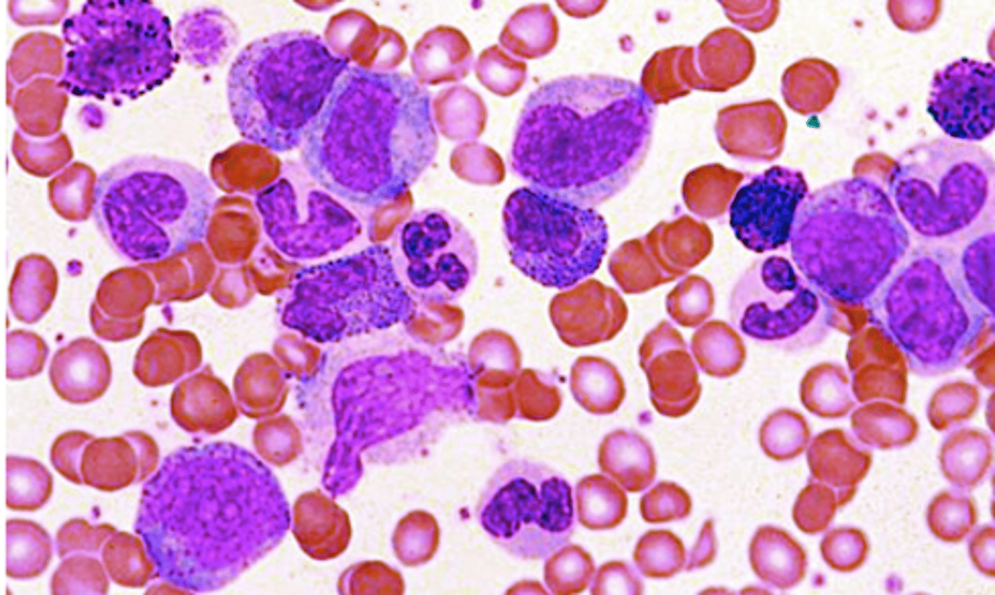 <p>most common neoplasm causing basophilia</p>