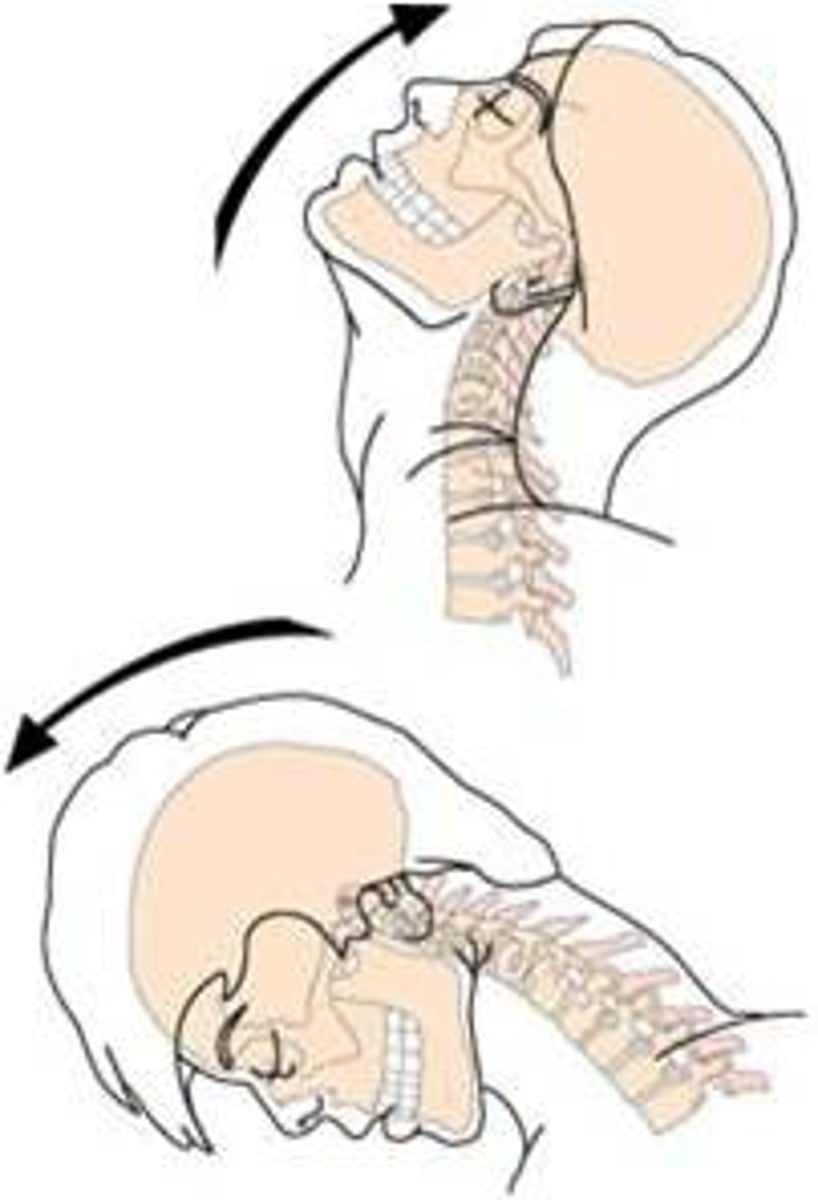 <p>Trauma to the cervical vertebrae, usually the result of a car accident (hyperextension and hyperflexion)</p><p>Injury to the anterior longitudinal ligament - causing painful muscle spasms </p>
