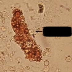 <ol><li><p>Identify cast.</p></li><li><p>What syndrome is this cast frequently associated with?</p></li></ol><p></p>