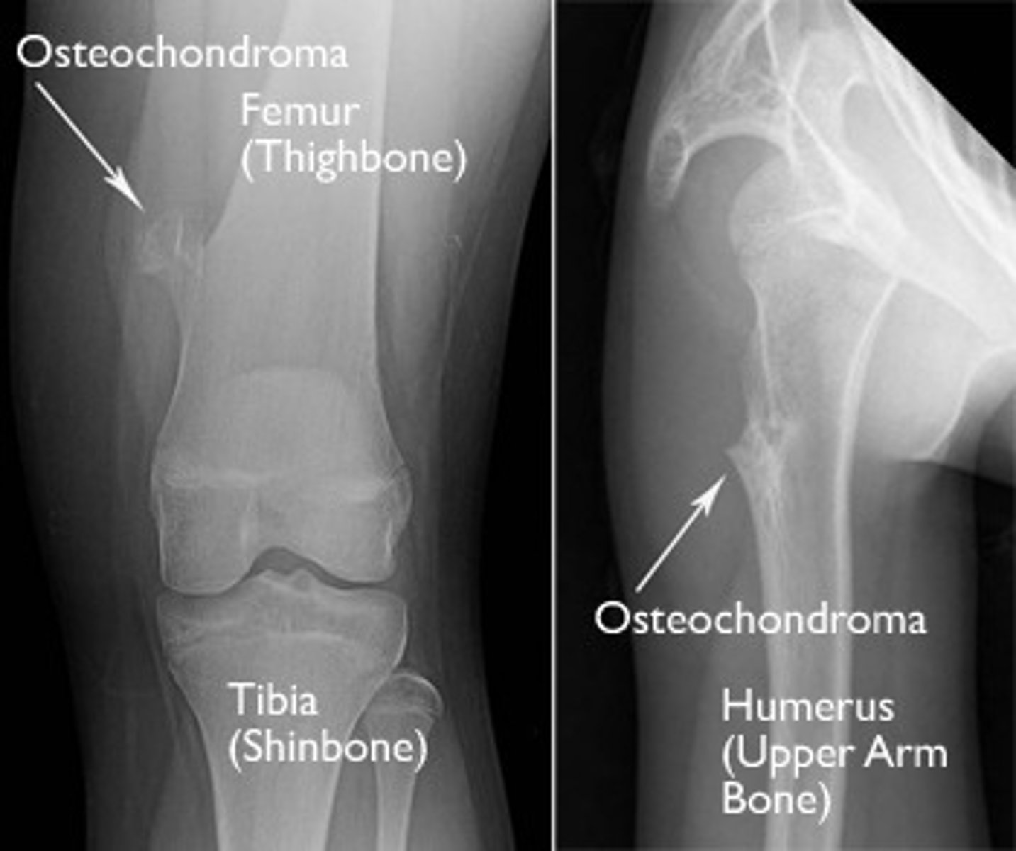 <p>Most common benign tumor of bone</p><p>- It produces a growth that grows laterally out of the epiphyseal growth plate</p><p>- The growth has a cartilage cap on it</p>