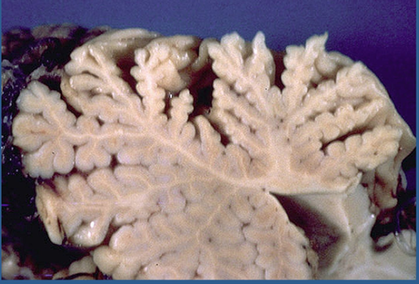 <p>Caused by certain specific inherited disorders</p><p>Symptoms: gait ataxia, dysarthria, intention tremor</p>