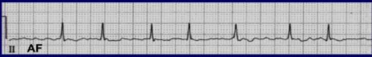 <p>If you see the following on an EKG, what arrhythmia is the heart in?</p><p>• Lack of P waves</p><p>• Irregularity of R waves (irregularly irregular)</p>