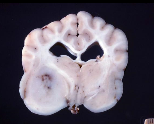 <p>13.&nbsp; Tissue from a dog.&nbsp; What is the most appropriate morphologic diagnosis?</p><ol type="a"><li><p>Astrocytoma</p></li><li><p>Gliomatosis cerebri</p></li><li><p>Ependymoma</p></li><li><p>Oligodendroglioma</p></li></ol><p></p>