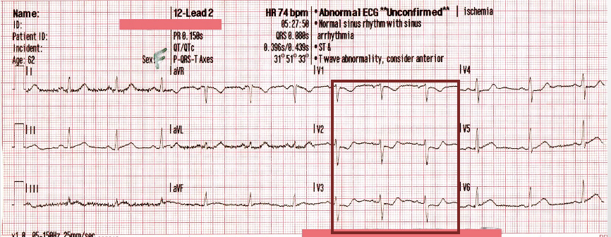 <p>ST depression in leads V1-4</p>